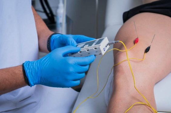 TRATAMIENTO DE PUNTOS GATILLO MIOFASCIALES → PUNCIÓN SECA EL EJIDO